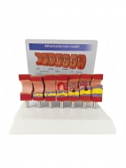 Разборная анатомическая модель атеросклероза сосуда Corpo de Atherosclerosis